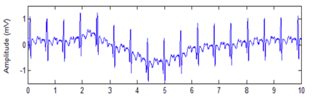 Baseline Wander Noise