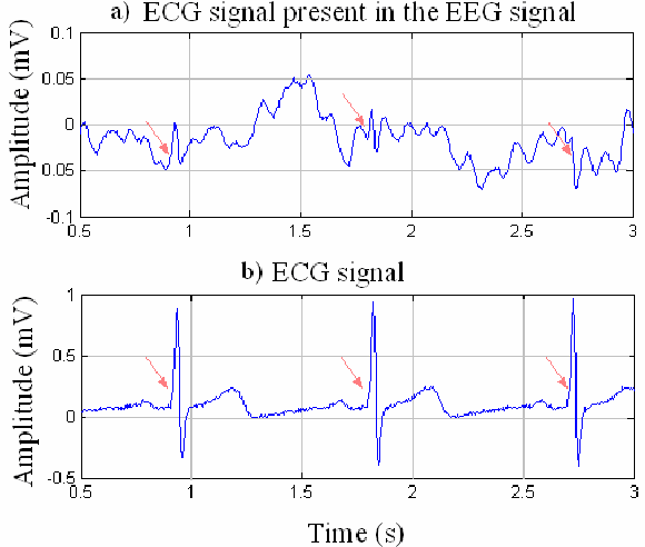 EEG
