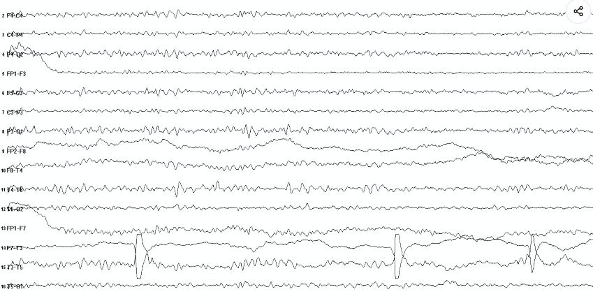 EEG